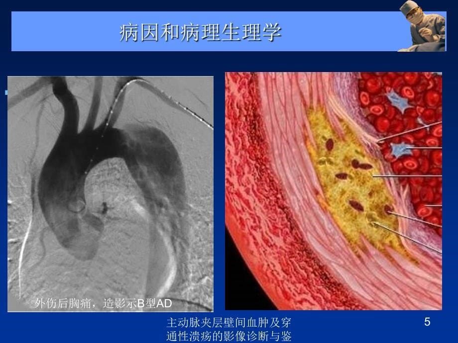 主动脉夹层壁间血肿及穿通性溃疡的影像诊断与鉴别诊断培训课件_第5页